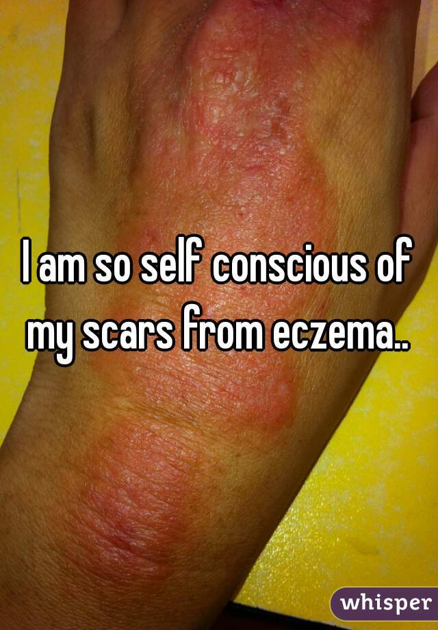 I am so self conscious of my scars from eczema.. 