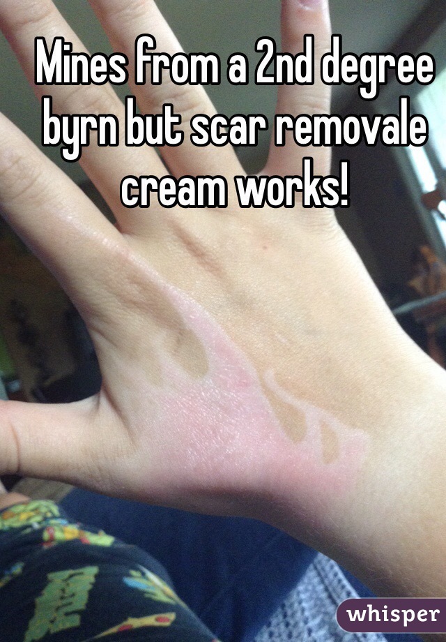 Mines from a 2nd degree byrn but scar removale cream works!