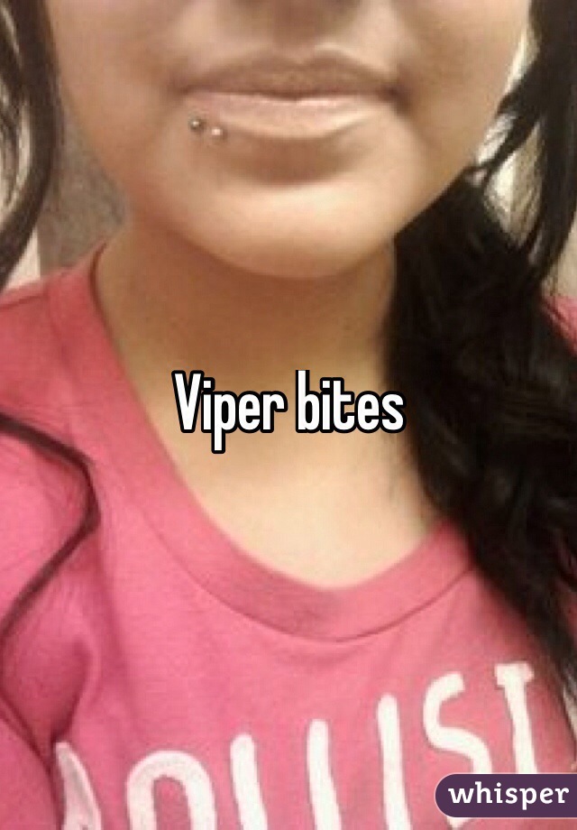 Viper bites
