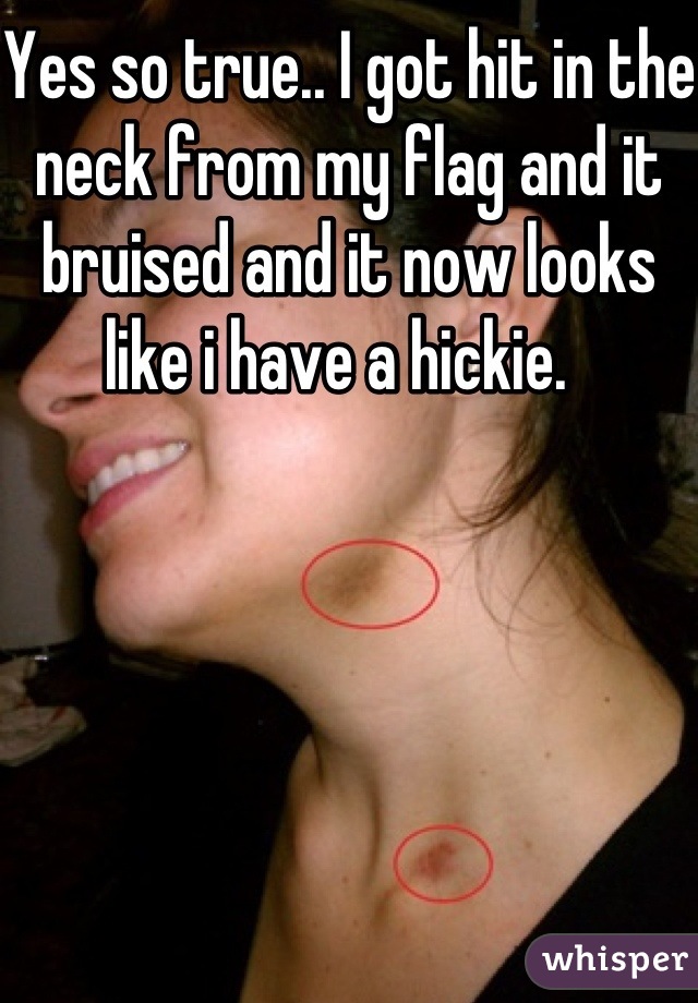 Yes so true.. I got hit in the neck from my flag and it bruised and it now looks like i have a hickie.  