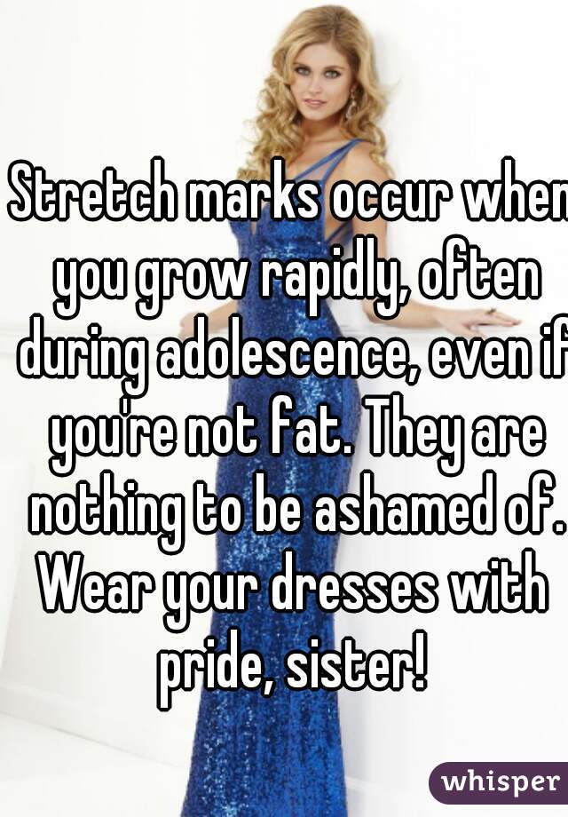 Stretch marks occur when you grow rapidly, often during adolescence, even if you're not fat. They are nothing to be ashamed of.
Wear your dresses with pride, sister! 