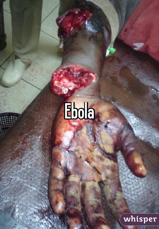 Ebola
