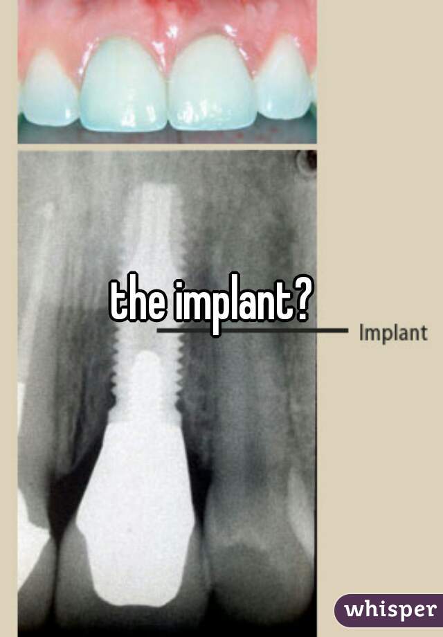the implant?  