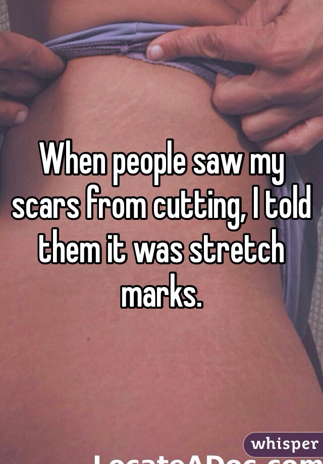 When people saw my scars from cutting, I told them it was stretch marks.