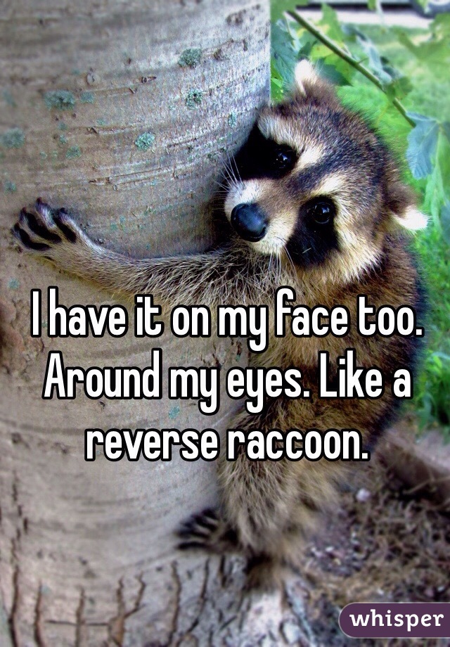 I have it on my face too. Around my eyes. Like a reverse raccoon.