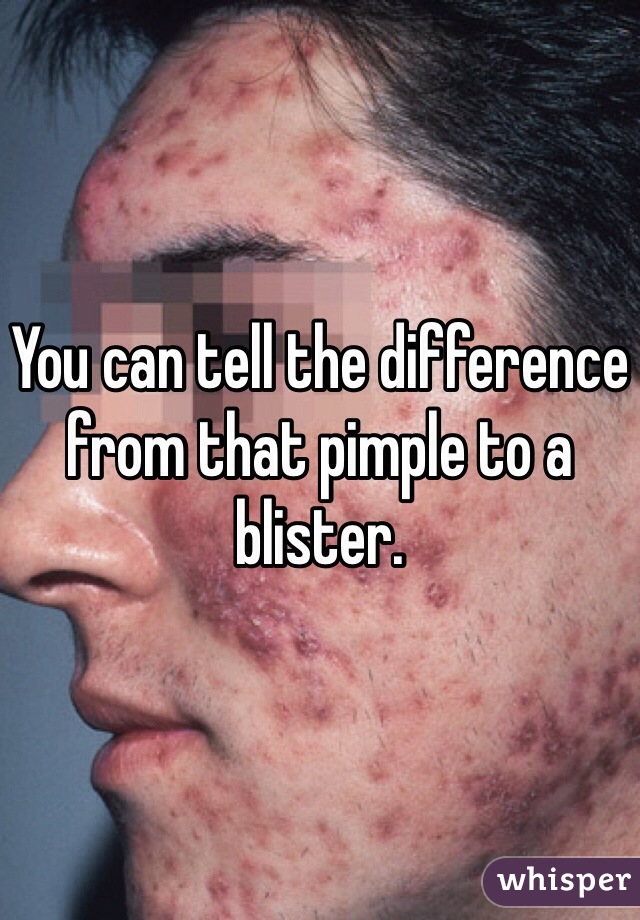 You can tell the difference from that pimple to a blister. 