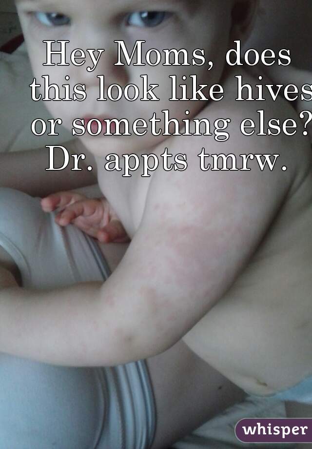 Hey Moms, does this look like hives or something else? Dr. appts tmrw. 
