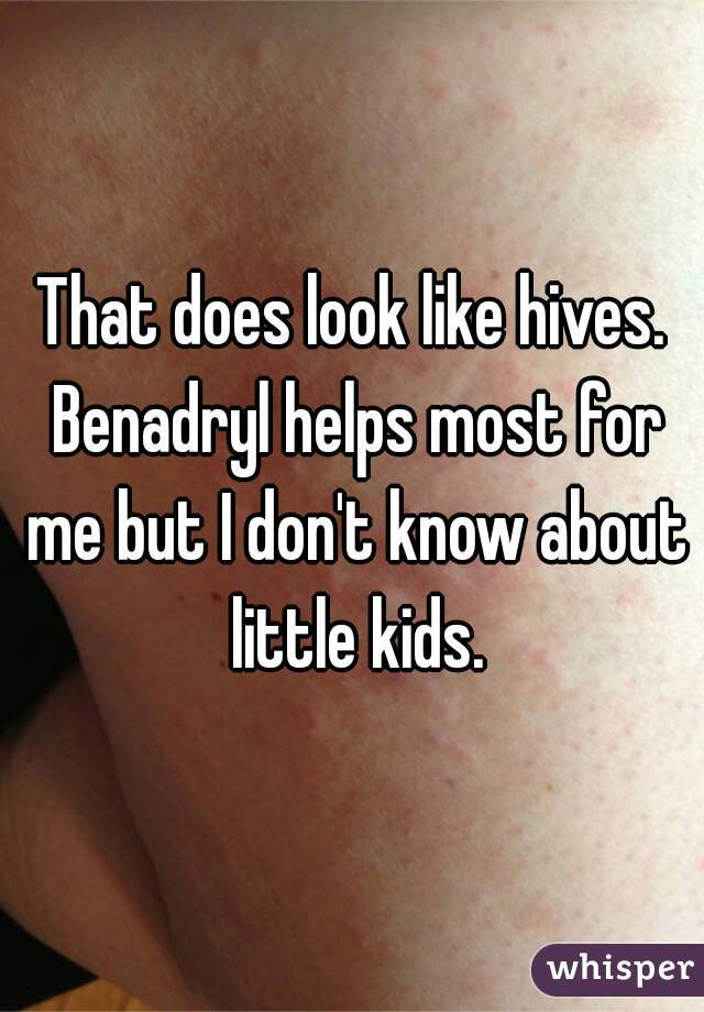 That does look like hives. Benadryl helps most for me but I don't know about little kids.