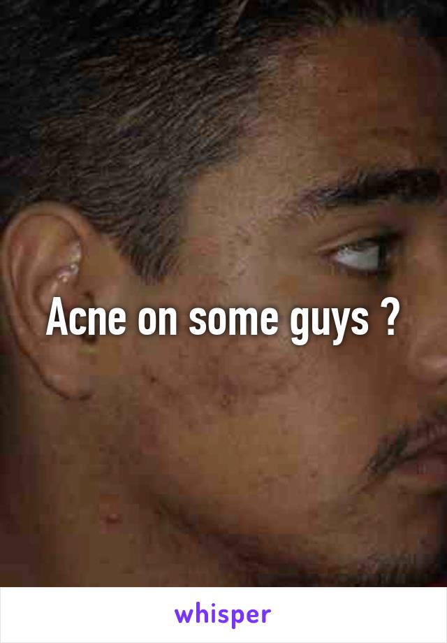 Acne on some guys 😍