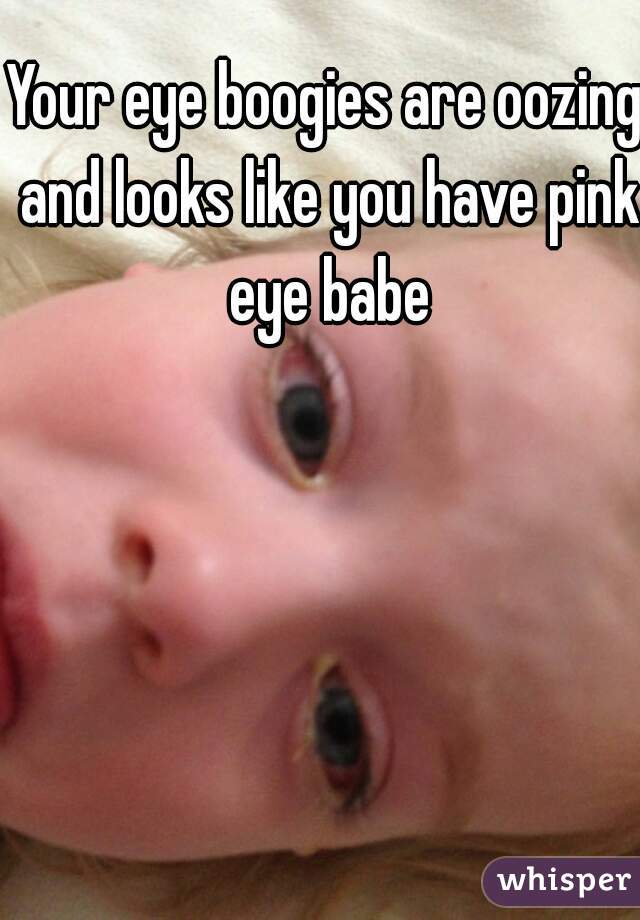 Your eye boogies are oozing and looks like you have pink eye babe