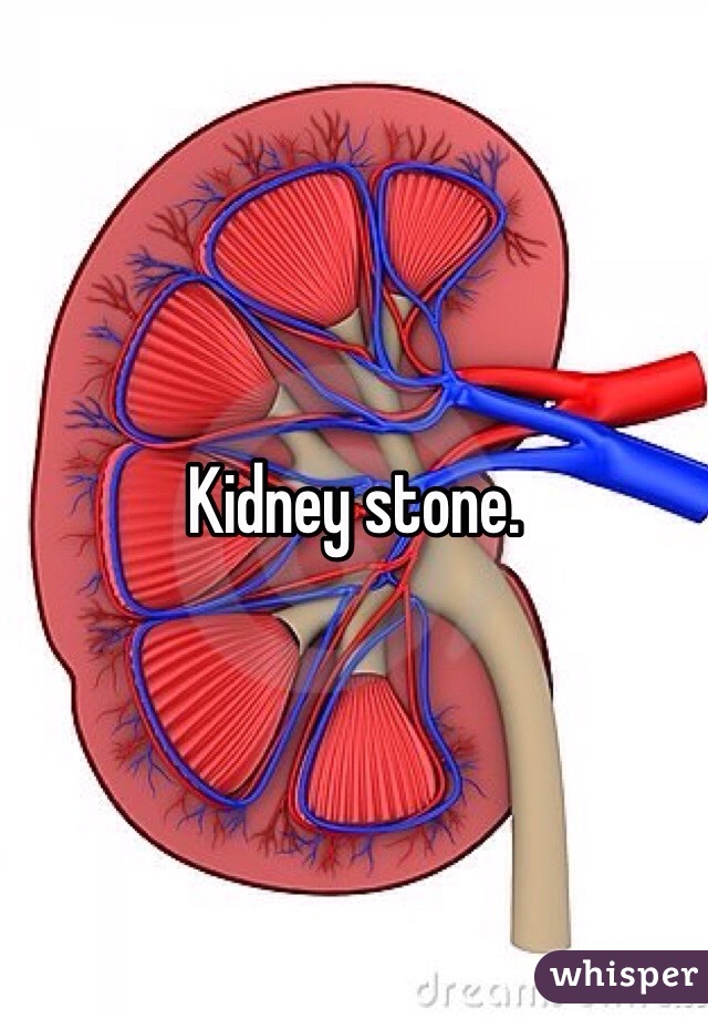 Kidney stone. 