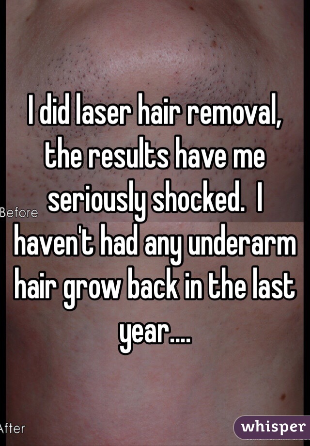I did laser hair removal, the results have me seriously shocked.  I haven't had any underarm hair grow back in the last year.... 