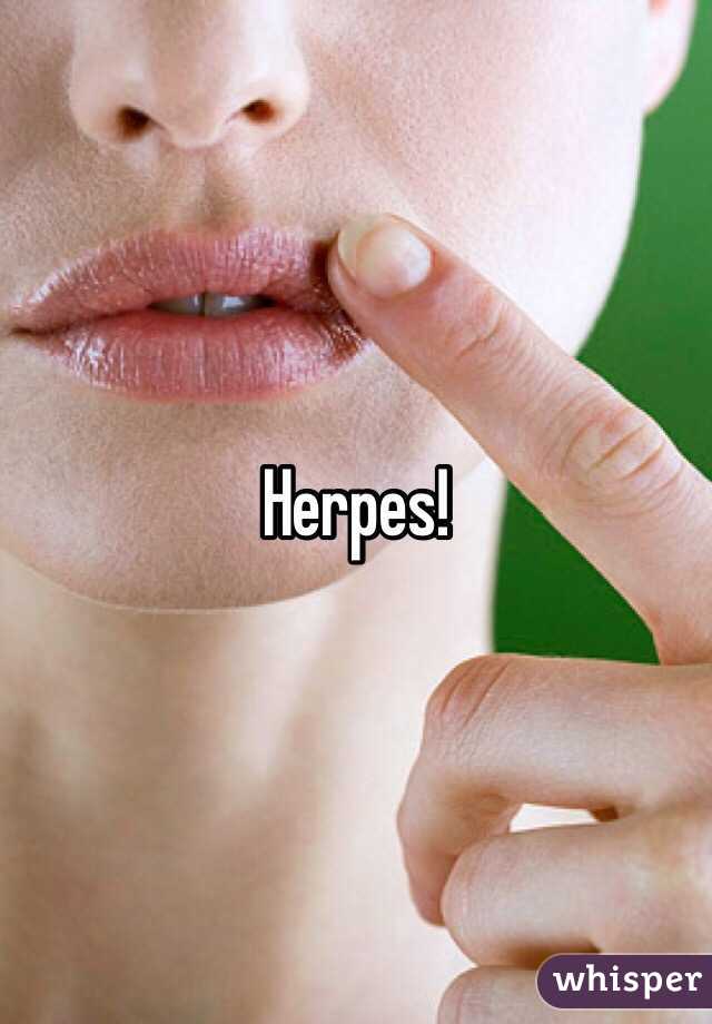 Herpes!