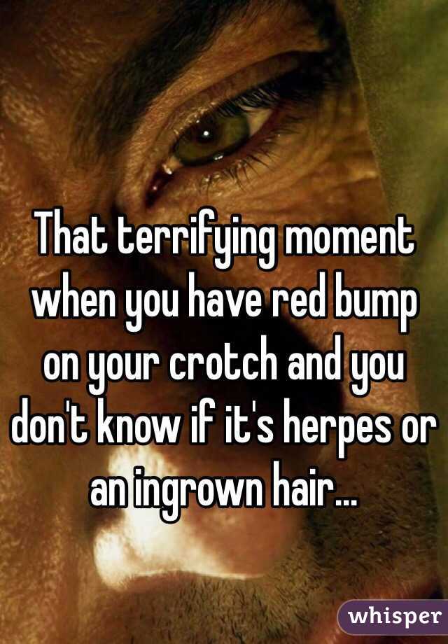 That terrifying moment when you have red bump on your crotch and you don't know if it's herpes or an ingrown hair...