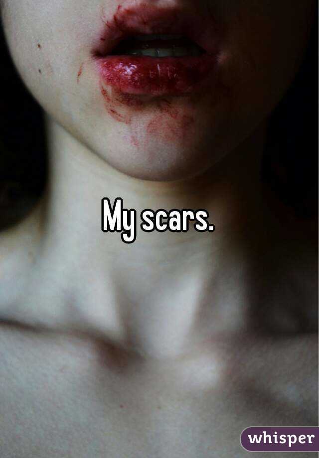 My scars.