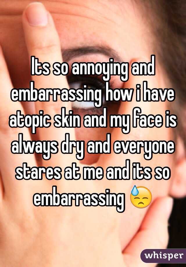 Its so annoying and embarrassing how i have atopic skin and my face is always dry and everyone stares at me and its so embarrassing 😓