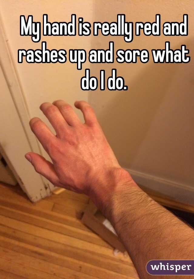 My hand is really red and rashes up and sore what do I do. 