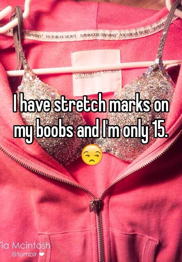 i-have-stretch-marks-on-my-boobs-and-i-m-only-15