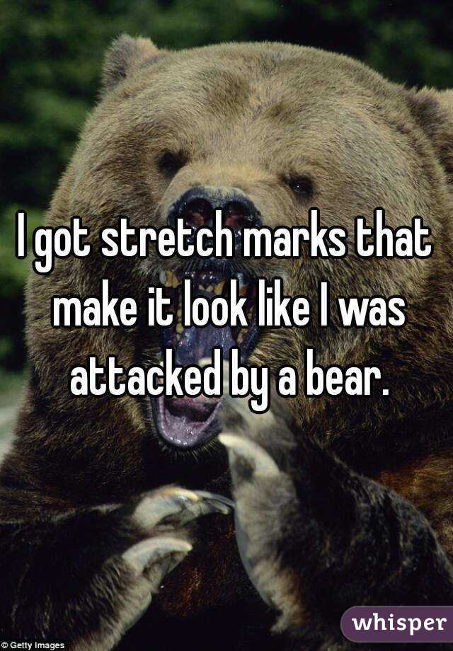 I got stretch marks that make it look like I was attacked by a bear.