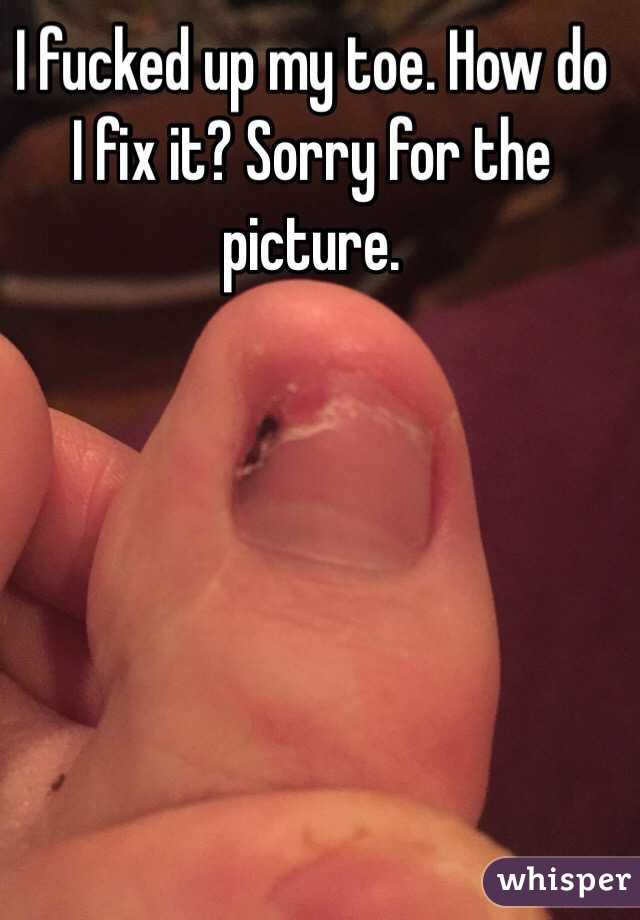 I fucked up my toe. How do I fix it? Sorry for the picture. 