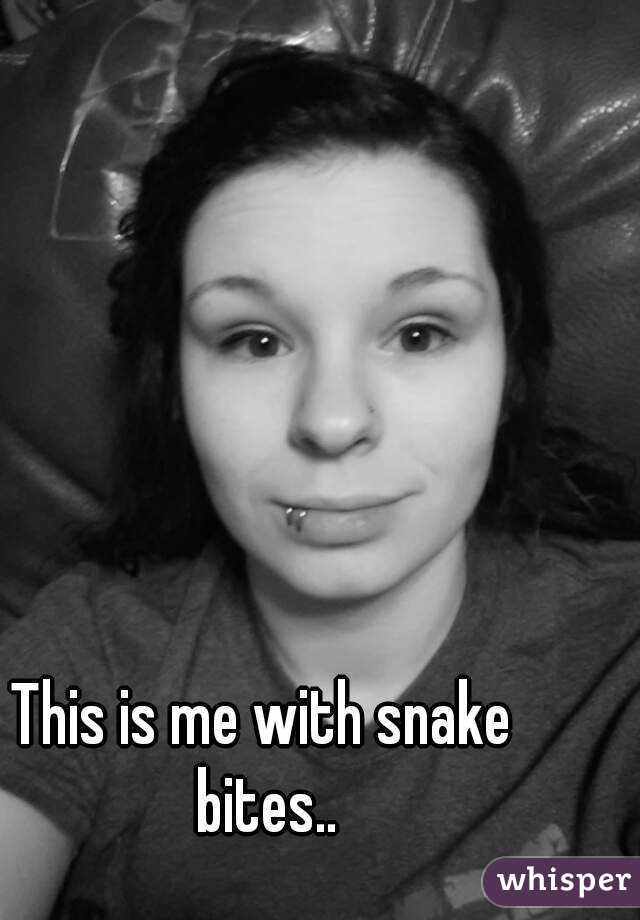 This is me with snake bites..