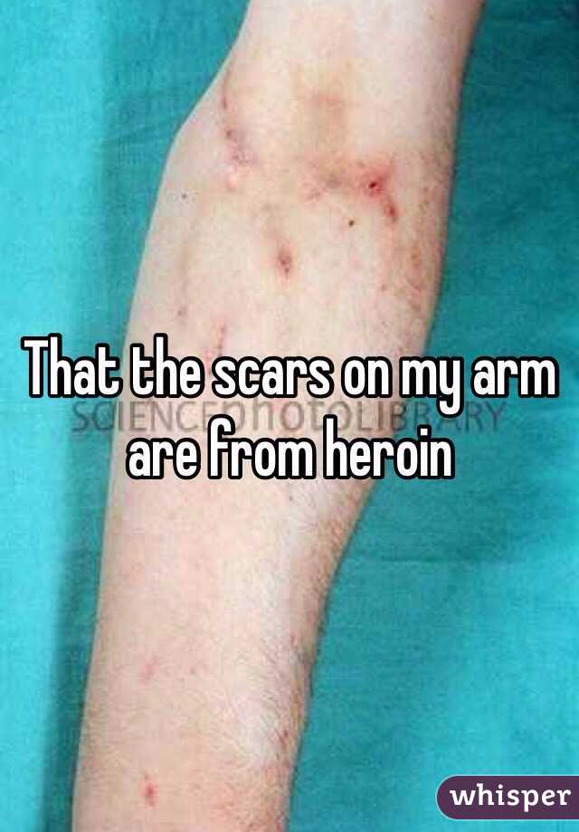 That the scars on my arm are from heroin