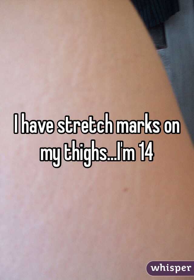 thigh stretch marks