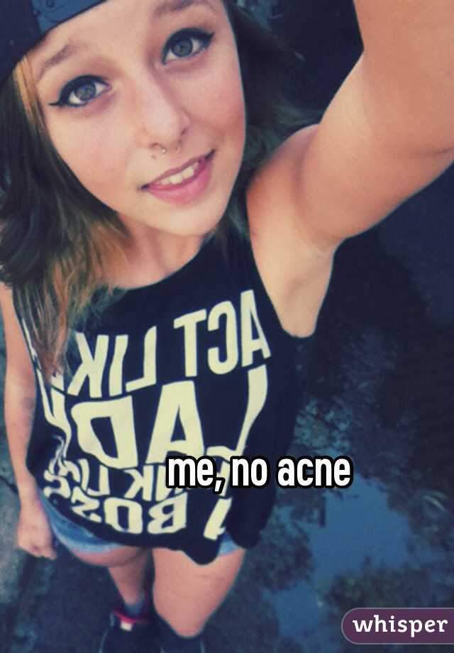 me, no acne