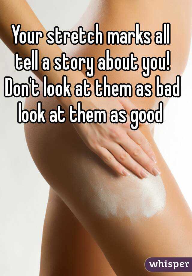 Your stretch marks all tell a story about you! Don't look at them as bad look at them as good 