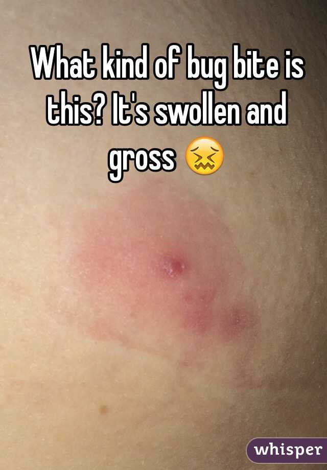 What kind of bug bite is this? It's swollen and gross 😖