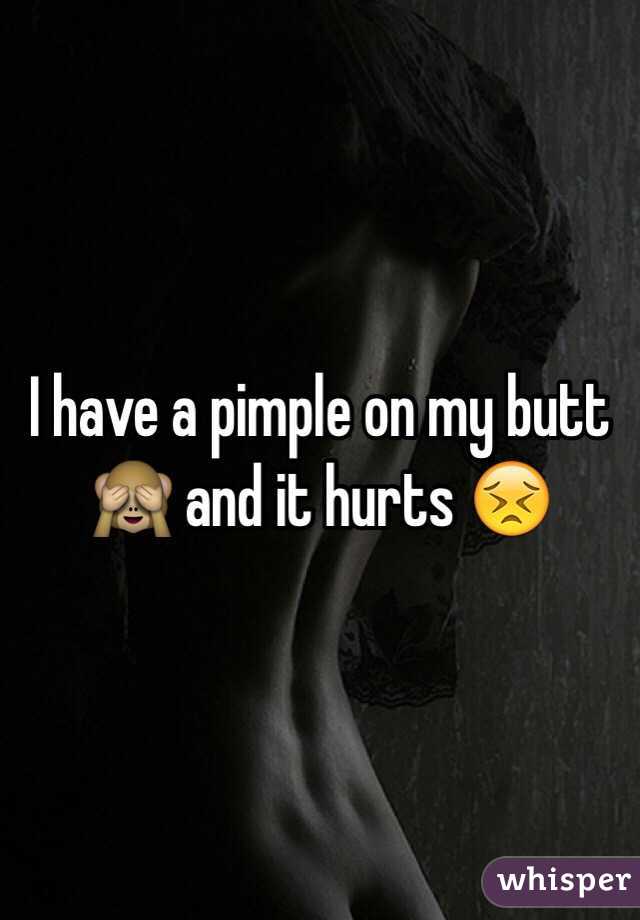 I have a pimple on my butt 🙈 and it hurts 😣
