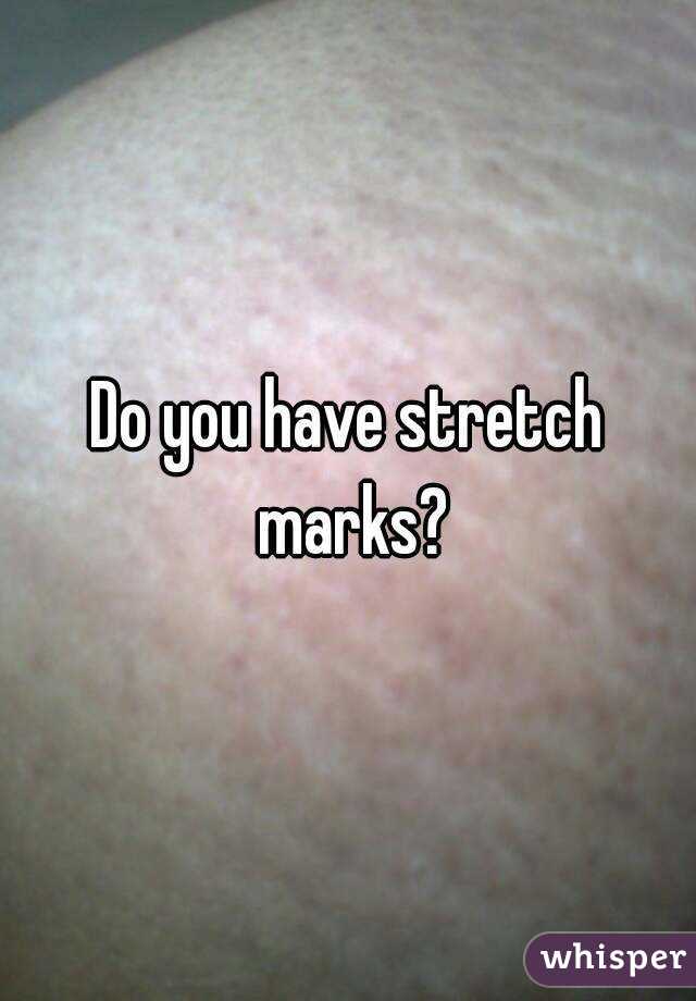 Do you have stretch marks?