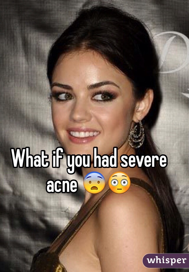 What if you had severe acne 😨😳