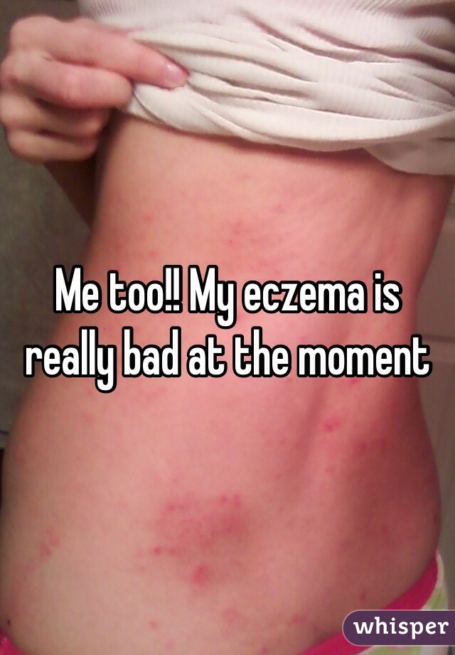 Me too!! My eczema is really bad at the moment 
