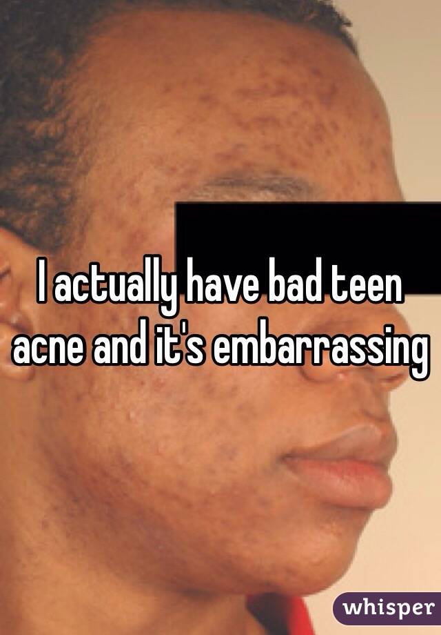 I actually have bad teen acne and it's embarrassing 