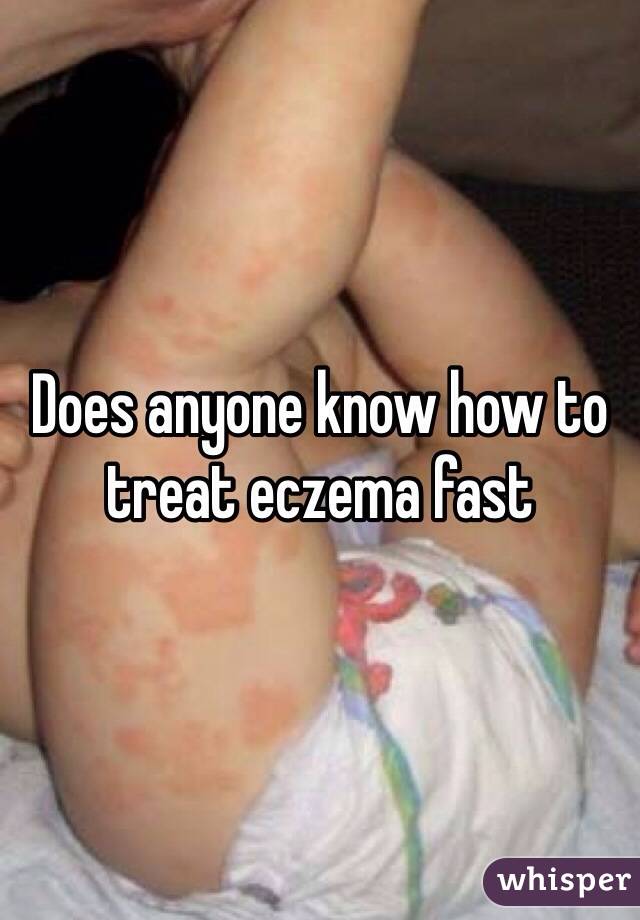 Does anyone know how to treat eczema fast 