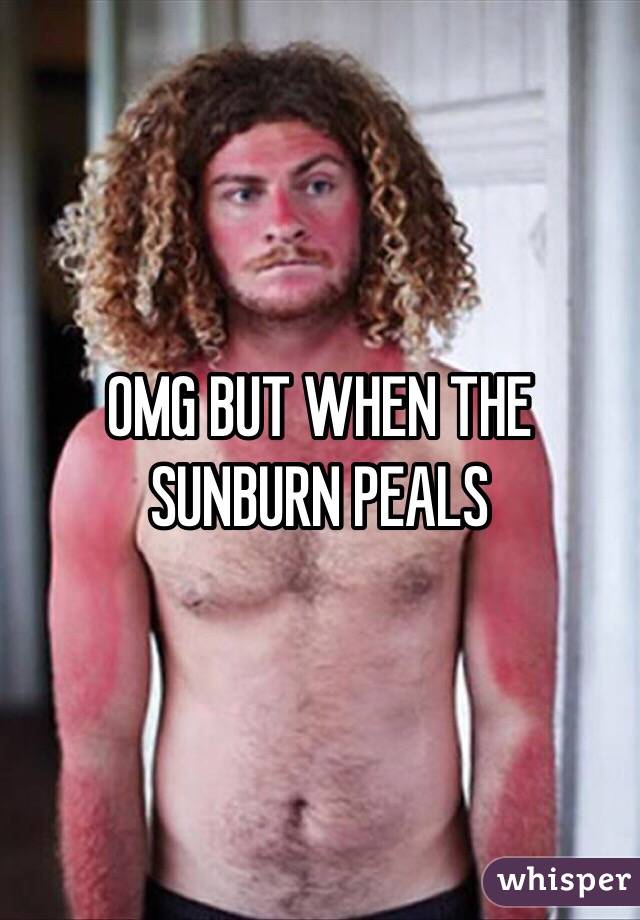 OMG BUT WHEN THE SUNBURN PEALS