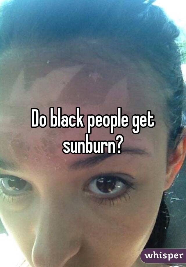 Do black people get sunburn?