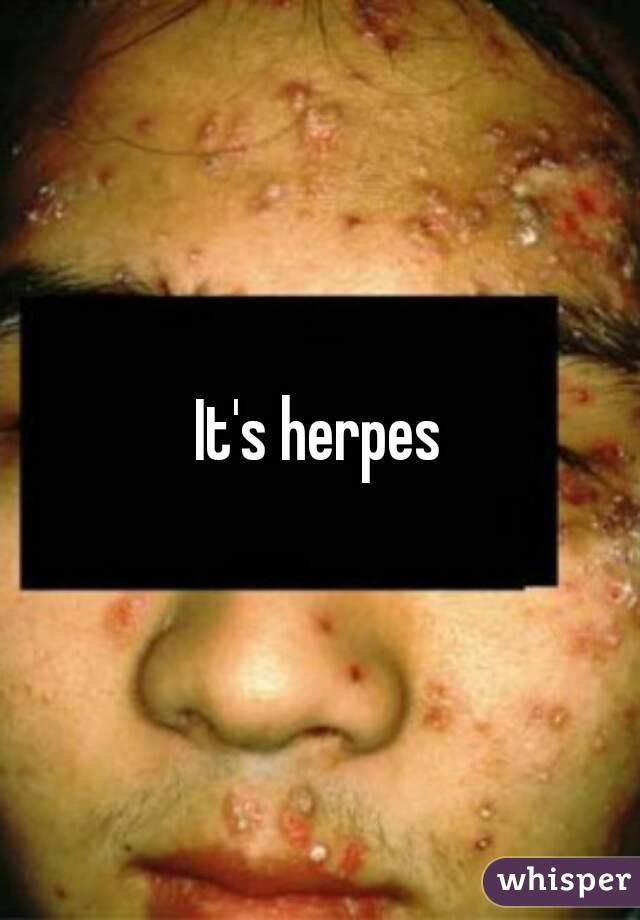 It's herpes