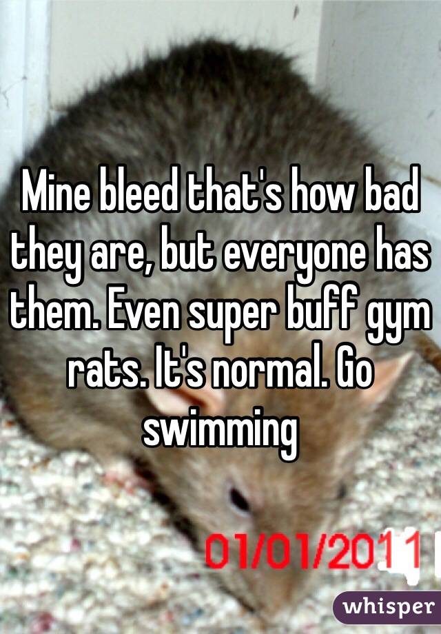 Mine bleed that's how bad they are, but everyone has them. Even super buff gym rats. It's normal. Go swimming 