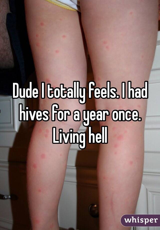 Dude I totally feels. I had hives for a year once. Living hell 
