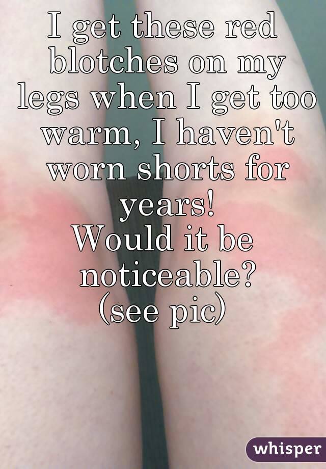 I get these red blotches on my legs when I get too warm, I haven't worn shorts for years!
Would it be noticeable?
(see pic)