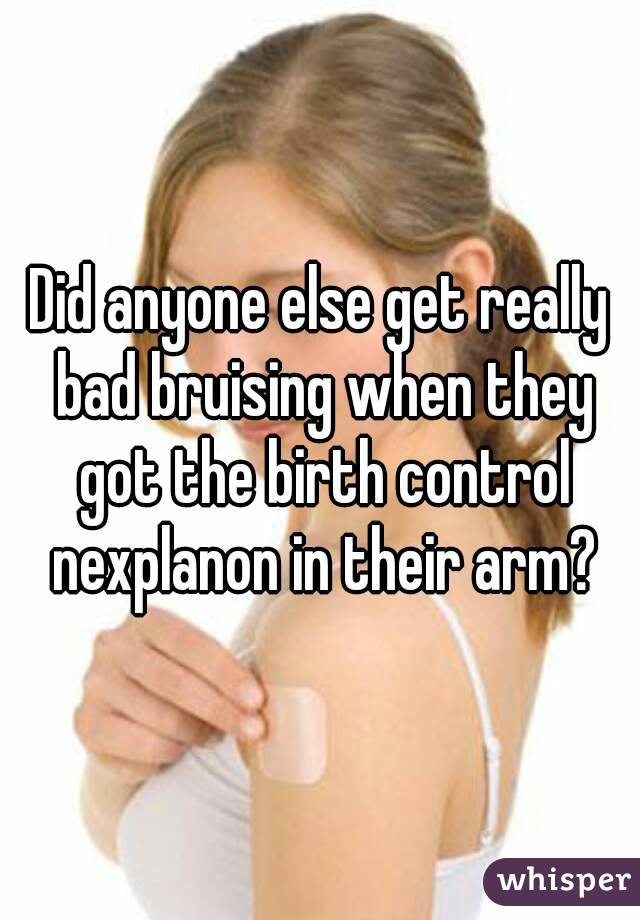 Did anyone else get really bad bruising when they got the birth control nexplanon in their arm?