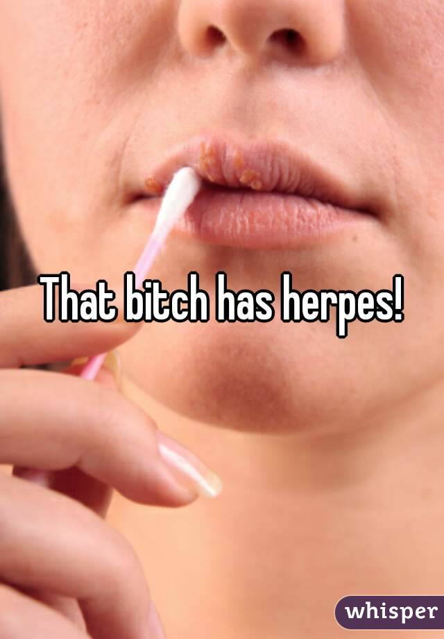 That bitch has herpes!
