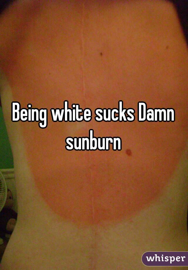 Being white sucks Damn sunburn 