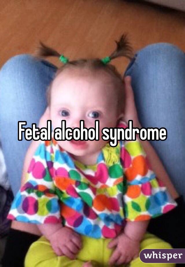 Fetal alcohol syndrome 