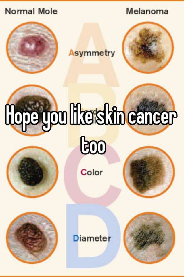 Hope you like skin cancer too