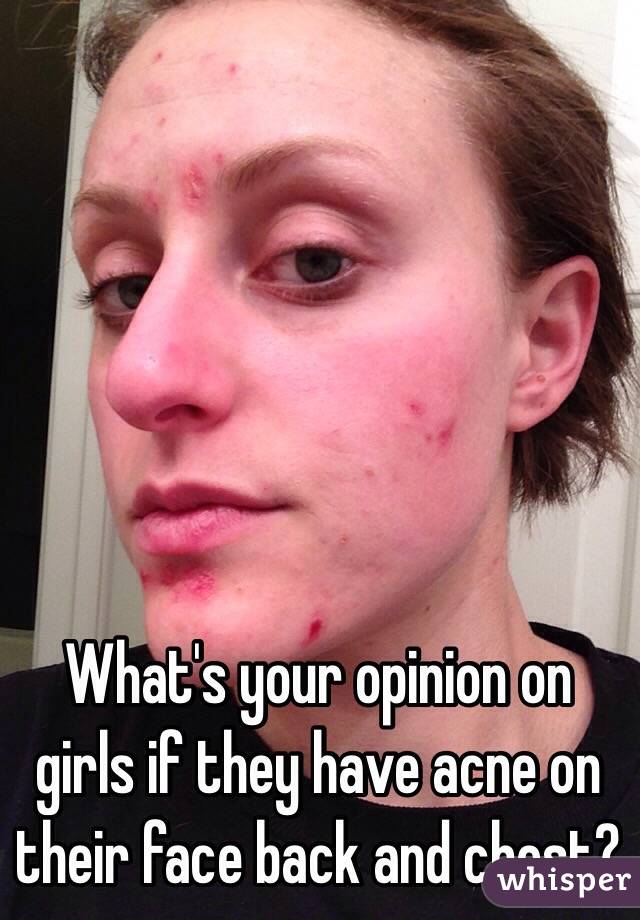 What's your opinion on girls if they have acne on their face back and chest?