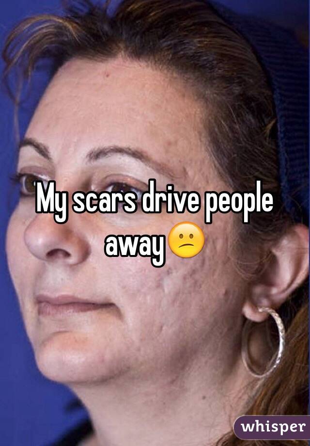 My scars drive people away😕