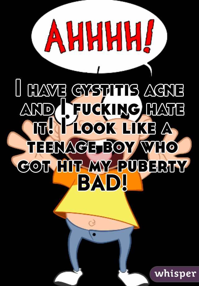I have cystitis acne and I fucking hate it! I look like a teenage boy who got hit my puberty BAD!